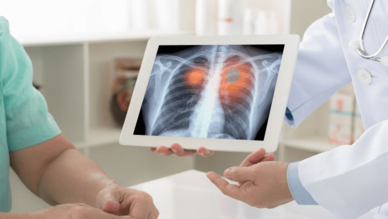 Accesul la Terapia Ţintită pentru Pacienţii cu Cancer Pulmonar ALK-Pozitiv: O Nouă Speranţă în Lupta Împotriva Bolii