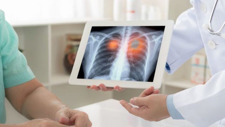 Accesul la Terapia Ţintită: O Nouă Speranţă pentru Pacienţii cu Cancer Pulmonar ALK-Pozitiv în România
