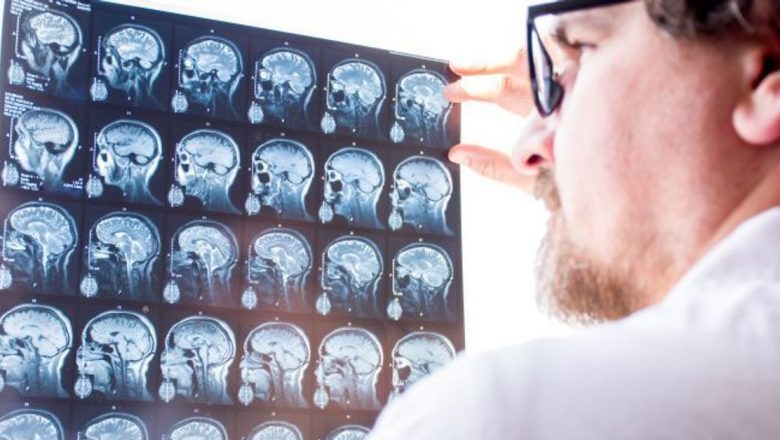 Anevrismul cerebral: Ce trebuie să știm despre această afecțiune amenințătoare de viață