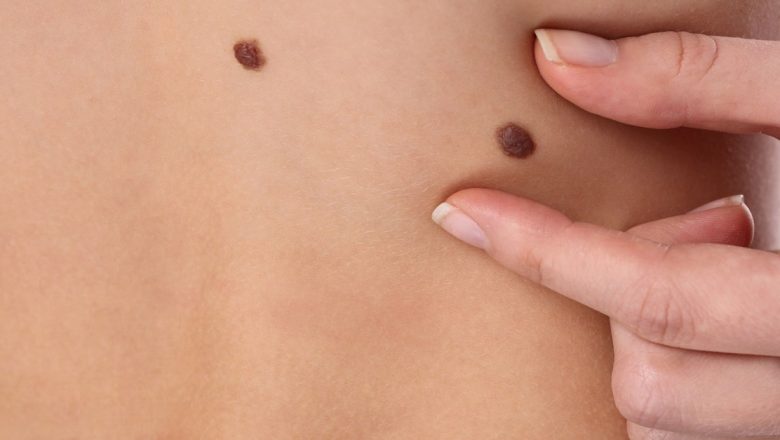 Platforma Digitală de Educație pentru Prevenirea Cancerului de Piele: O Inițiativă Vitală în Era Expunerii Necontrolate la Soare