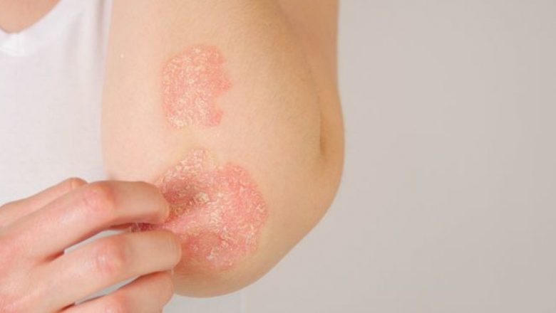 Psoriazisul: O privire detaliată asupra provocărilor și soluțiilor