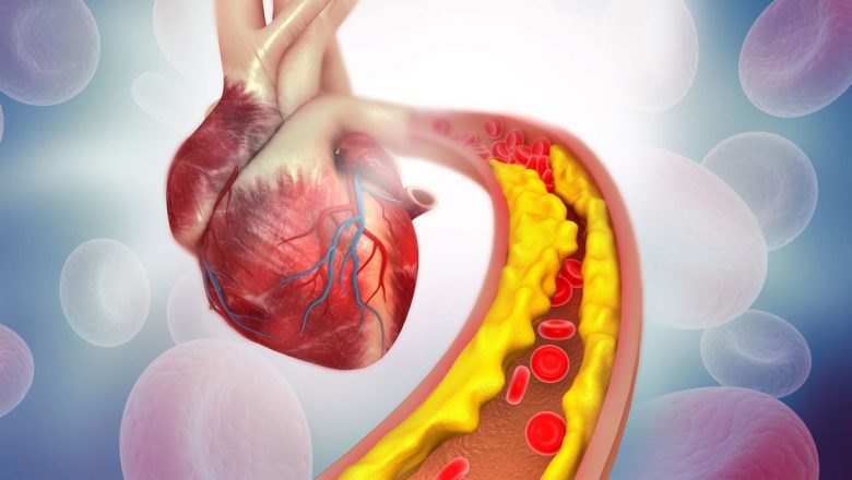 Ateroscleroza: Cauze, Factori de Risc și Impactul Asupra Sănătății Cardiovasculare