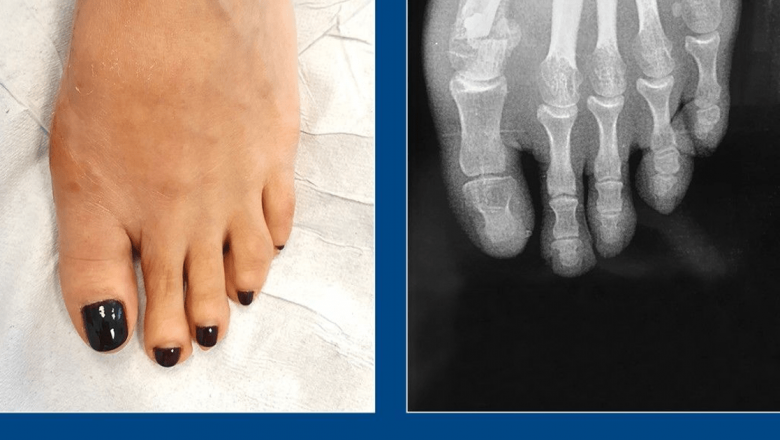Monturile piciorului: o privire detaliată asupra hallux valgus și soluțiile chirurgicale necesare
