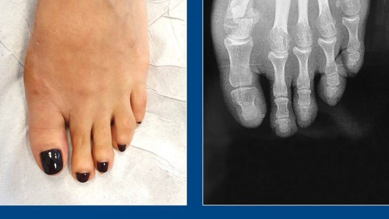 Monturile piciorului: cauze, tratamente și intervenții chirurgicale pentru corectarea hallux valgus