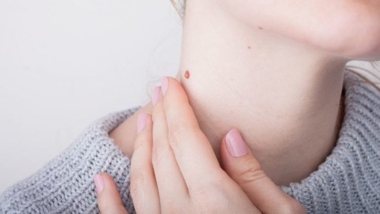 Tratamente Eficiente pentru Îndepărtarea Negilor: O Analiză Detaliată a Metodelor și Implicațiilor