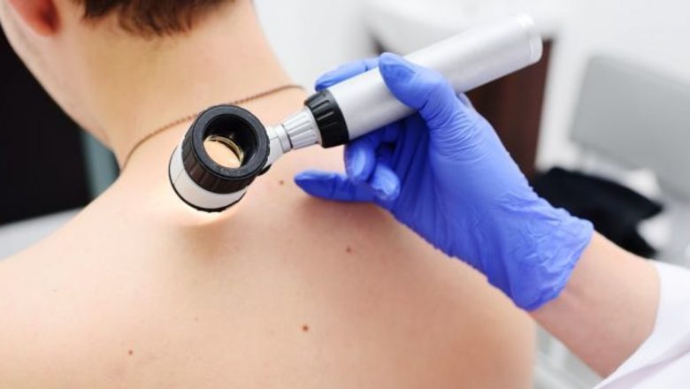Importanța Dermatoscopiei: Cum Să Identifici Alunițele Suspecte și Să Îți Protejezi Sănătatea