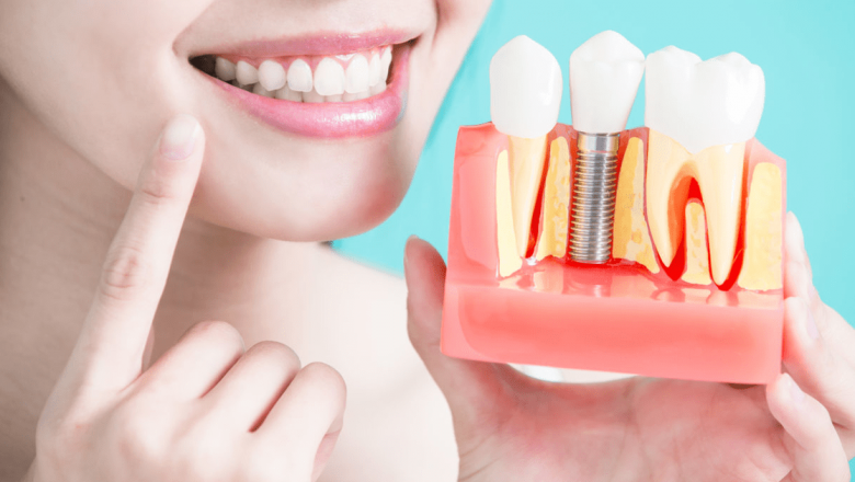 Implanturi dentare: Calea spre un zâmbet perfect și încredere sporită