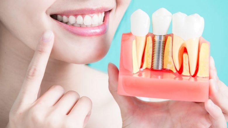 Revoluția Implanturilor Dentare: Un Zâmbet Perfect la Îndemână