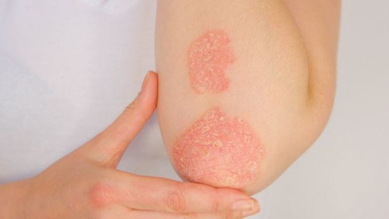 Vaccinarea anti COVID-19 pentru pacienții cu boli dermatologice: Ghid complet și perspective de sănătate publică