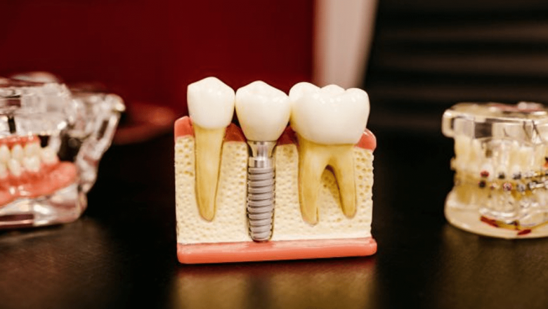 Revoluția în Îngrijirea Dentară: Implanturi Dentare în Rate Fără Dobândă – O Nouă Oportunitate pentru Pacienți