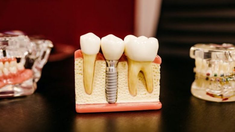 Accesibilitatea implanturilor dentare: Oferte fără dobândă pentru o dantură sănătoasă