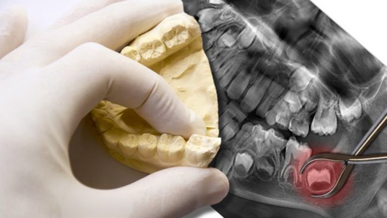 Măseaua de minte: Rădăcinile evoluției, problemele contemporane și soluțiile dentare