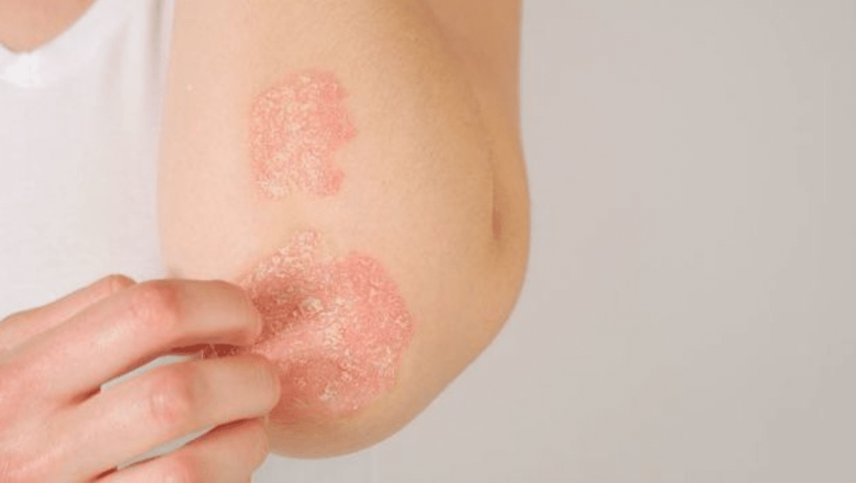 Îngrijirea Psoriazisului în Sezonul Estival: Beneficiile și Provocările Expunerii la Soare