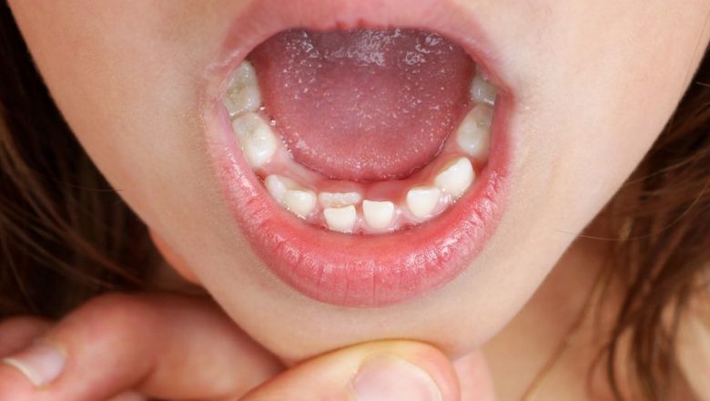 Dinții de rechin: Fenomenul natural al dezvoltării dentiției la copii