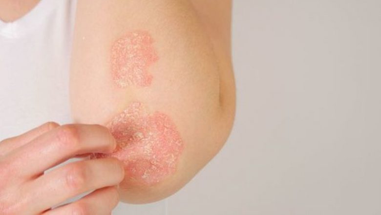 Psoriazisul și vara: Cum soarele poate ajuta la ameliorarea afecțiunii