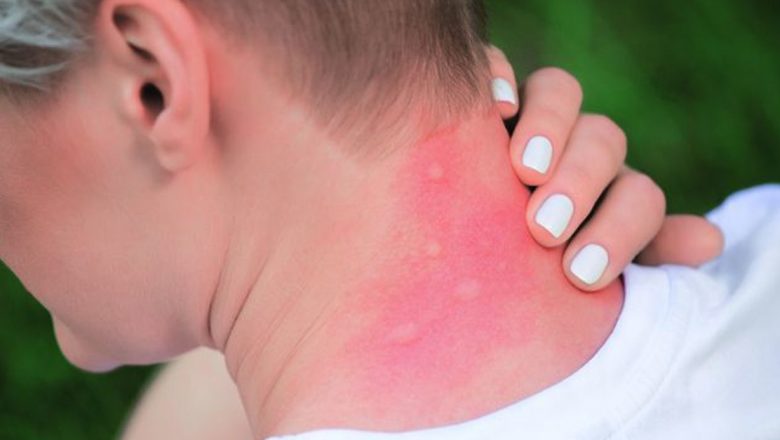 Ghid complet pentru gestionarea înțepăturilor de țânțari și alte insecte: Prevenire și tratament
