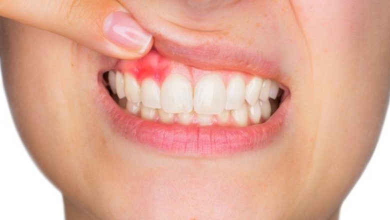 Gingivita: Înțelegerea, prevenirea și implicațiile acestei afecțiuni dentare frecvente