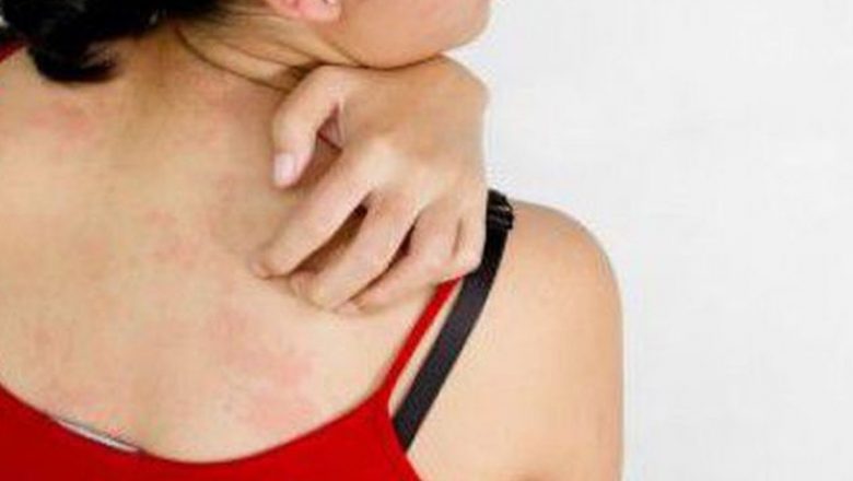 Alergia la soare: Înțelegerea, simptomatologia și tratamentele disponibile