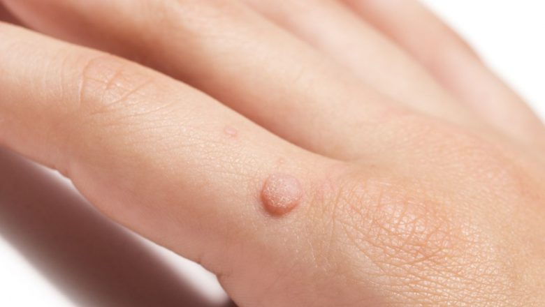 Remedii Naturiste Eficiente pentru Negi: Soluții Imediate și Implicații pe Termen Lung