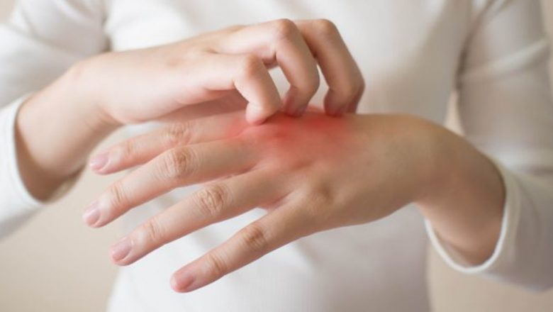 Soluții Naturale Eficiente pentru Combaterea Eczemelor: Plante și Remedii Care Fac Diferența