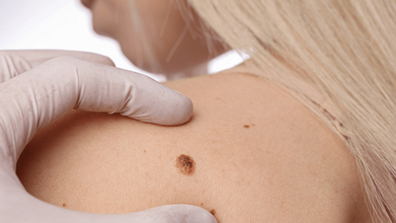 Dermatoscopia: O Fereastră către Sănătatea Pielii și Prevenția Cancerului