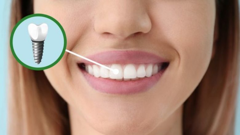 Implanturile Dentare: Tot Ce Trebuie să Știi pentru o Decizie Informata