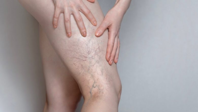 Remediul naturist care promite să combată varicele: Ceapa roșie ca soluție eficientă