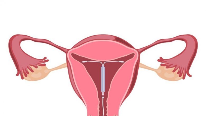 Steriletul: O metodă de contracepție eficientă, dar cu riscuri potențiale – Analiza detaliată a Dr. Ciprian Pop Began