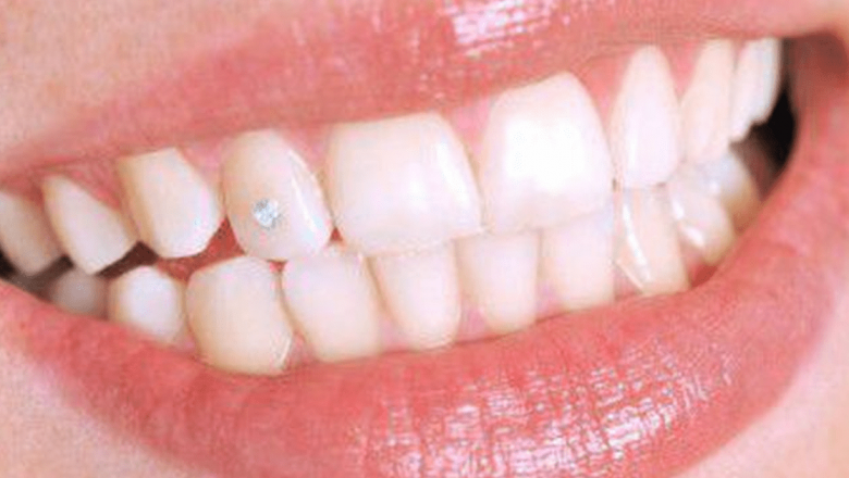Bijuteriile dentare: Eleganță sau risc pentru sănătatea orală?