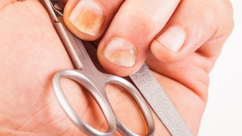 Ciuperca unghiei: simptome, tratamente și măsuri de prevenire pentru o sănătate optimă
