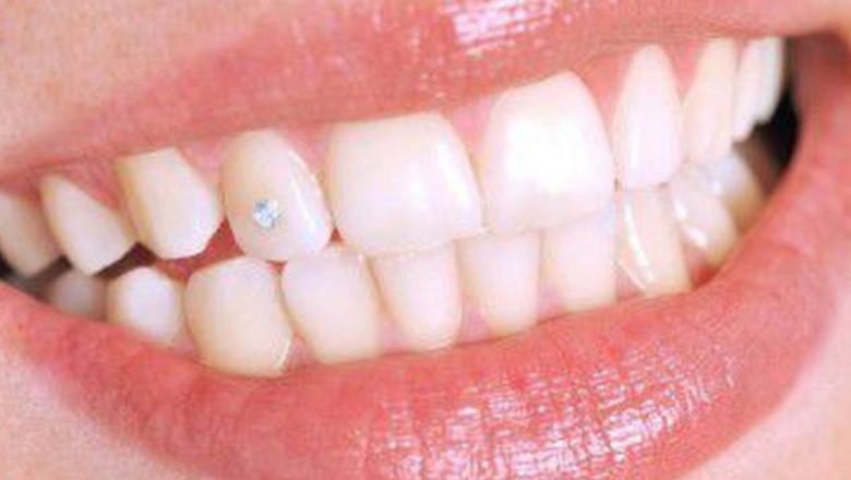 Bijuteriile dentare: Estetică, siguranță și implicații pentru sănătatea orală
