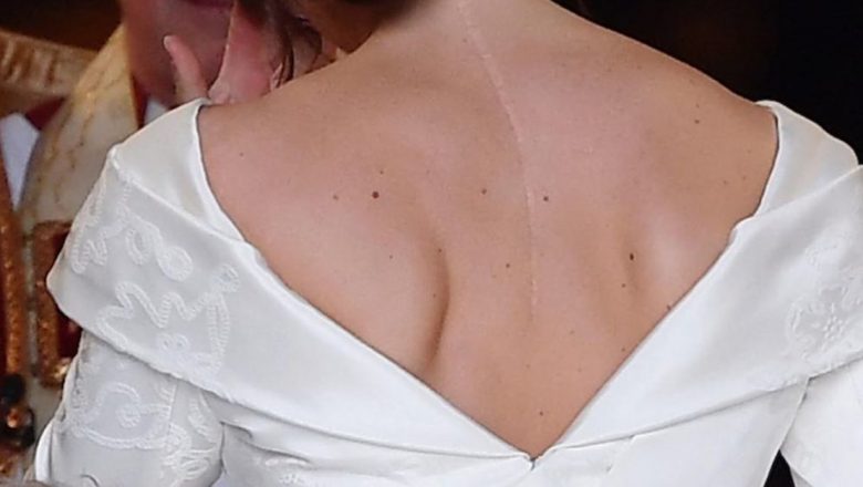 Cicatricea Prințesei Eugenie: O Poveste de Inspirație și Conștientizare a Scoliozei
