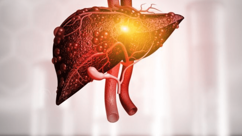 Alimentația în steatoza hepatică: Dieta esențială pentru sănătatea ficatului gras