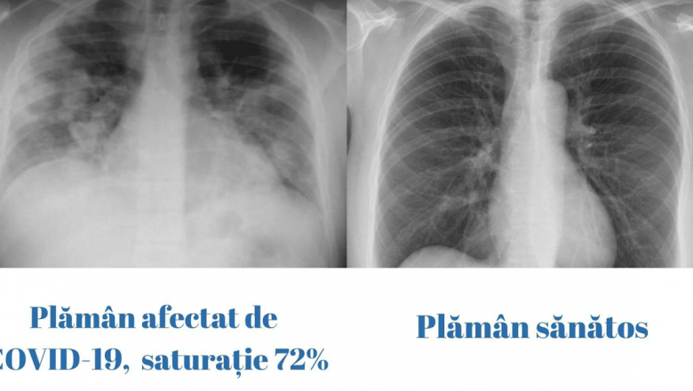 Impactul COVID-19 asupra sănătății pulmonare: O analiză detaliată a diferențelor între plămânii sănătoși și cei afectați