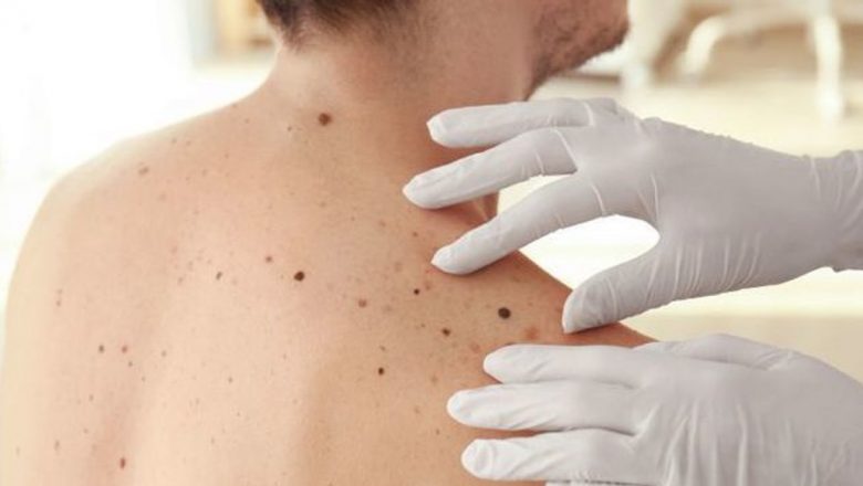 Importanța diagnosticării timpurii a melanomului: un apel la conștientizare și acțiune