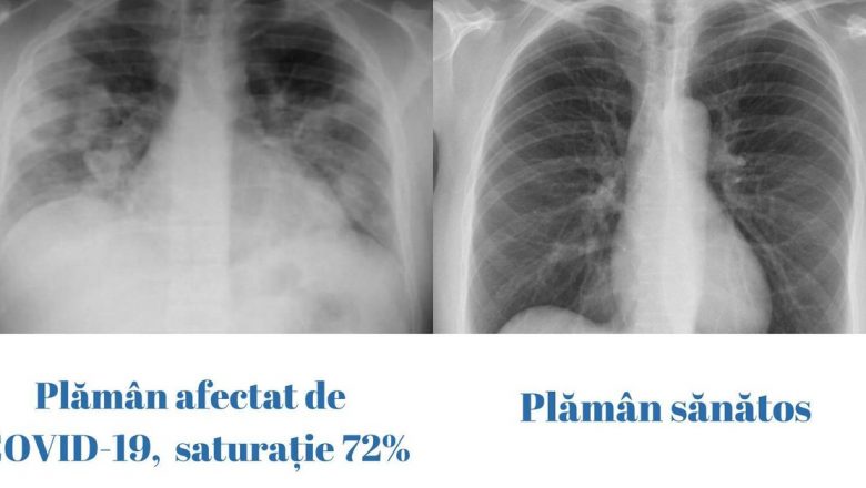 Impactul COVID-19 asupra sănătății pulmonare: O analiză detaliată a imaginilor radiografice