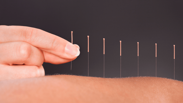 Efectele Benefice ale Acupuncturii: O Terapiă Străveche cu Impact Modern asupra Rinitei Alergice și Nu Numai