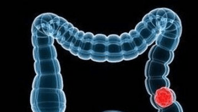 Cancerul colorectal: Mituri, realitate și importanța screening-ului timpurie