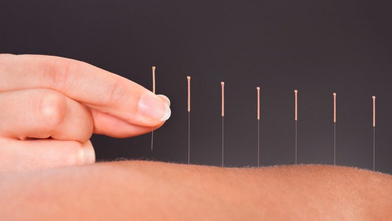Efectele Benefice ale Acupuncturii: O Privire Detaliată Asupra Impactului Său Asupra Sănătății