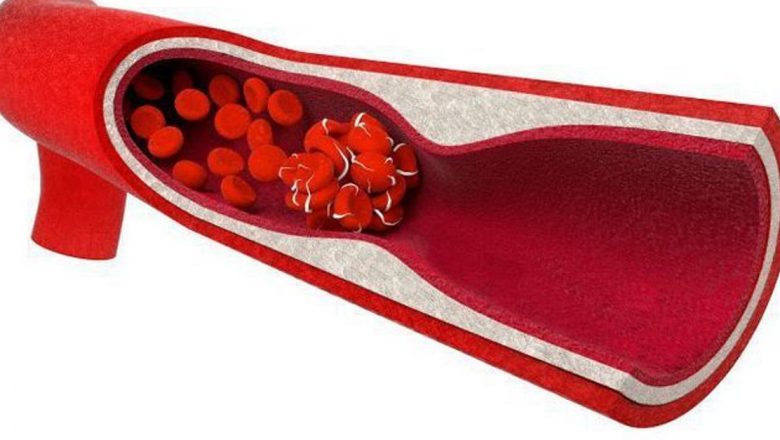 Prevenirea formării cheagurilor de sânge: Ghid complet pentru sănătatea cardiovasculară