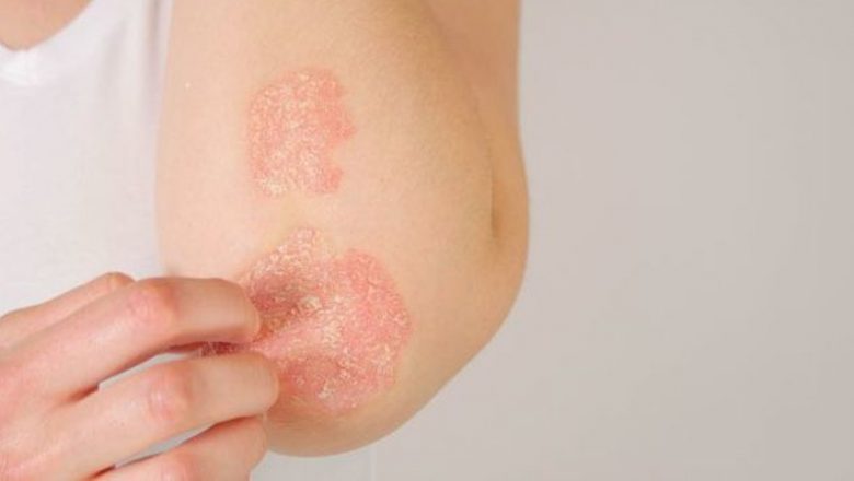 Psoriazisul: O Afecțiune Complexă cu Implicații Universale