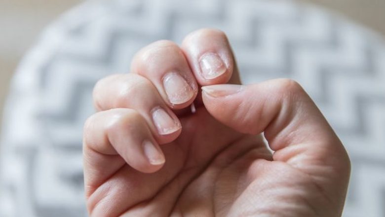 Exfolierea unghiilor: Cauze, implicații și soluții pentru o sănătate optimă