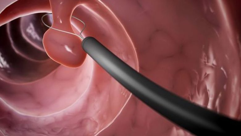 Polipii pe colon: De la formațiuni benigne la riscuri oncologice – o analiză detaliată