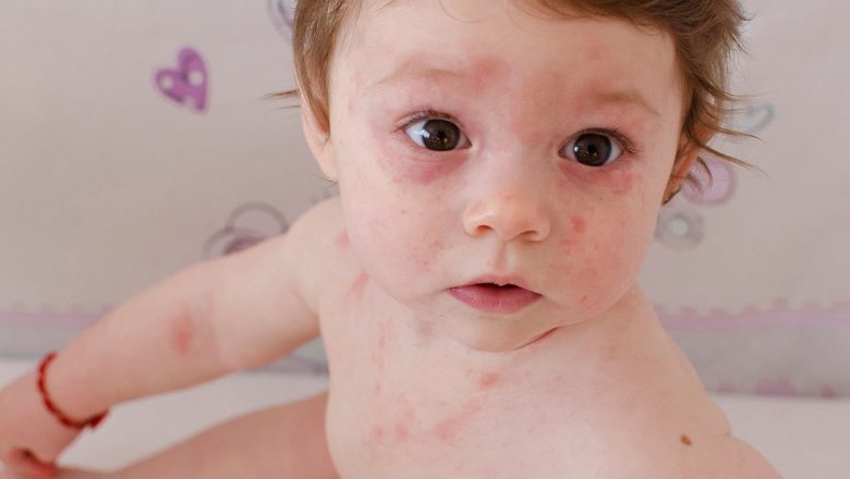 Rubeola la copii: Măsuri esențiale pentru prevenție și tratament