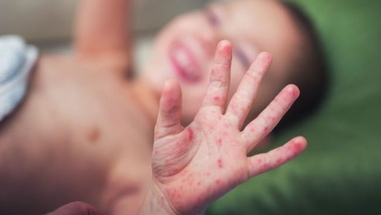 Boala gură-mână-picior la copii: Ghid complet de recunoaștere, tratament și prevenție