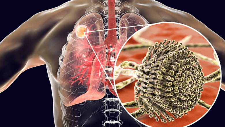 Aspergillus fumigatus: O Amenințare Crescendo în Lupta Împotriva Infecțiilor Fungice