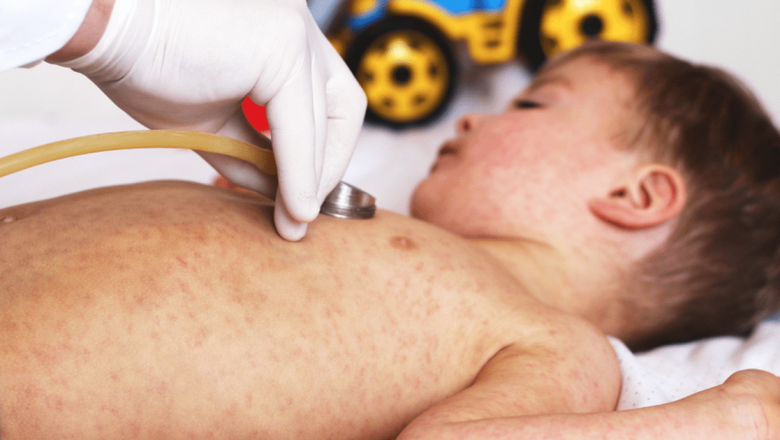 Rujeola în Creștere: Avertismentele Medicilor și Importanța Vaccinării la Copii