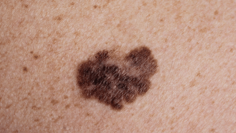 Cancerul de piele: Semnele de alarmă pe care nu trebuie să le ignori