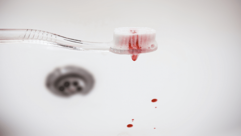 Sângerarea gingiilor: cauze, implicații și soluții pentru o sănătate dentară optimă