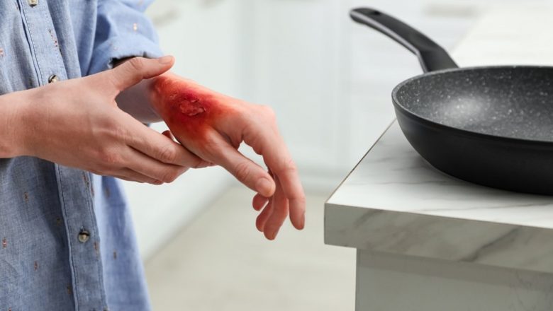 Ghid complet pentru îngrijirea arsurilor domestice: ce trebuie să știi după un accident în bucătărie